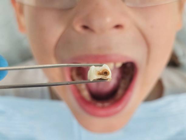 Best Emergency Tooth Extraction in Ness City, KS